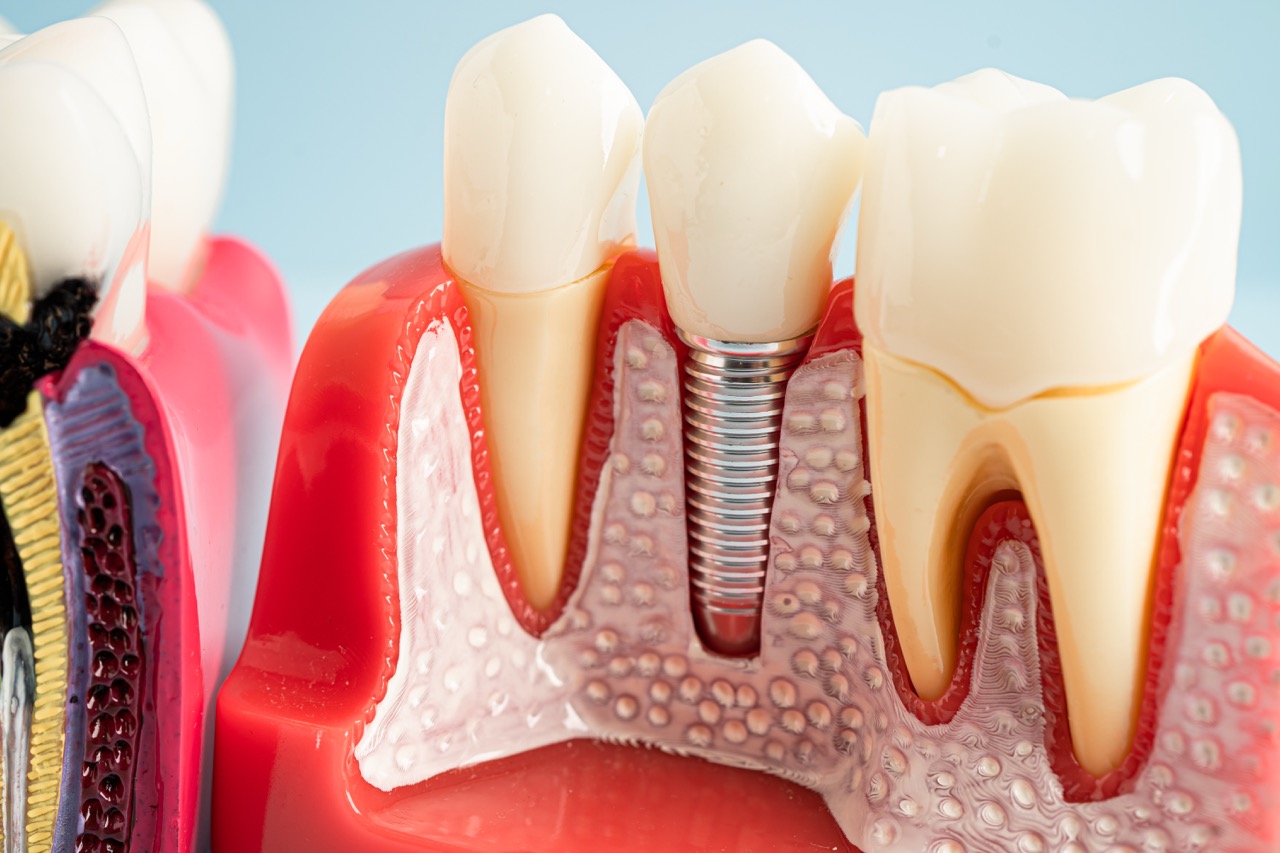 Sleep Dentistry for Dental Implants & All-on-4®